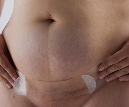 Silicone Gel Scar Strips: 3 STRIPS